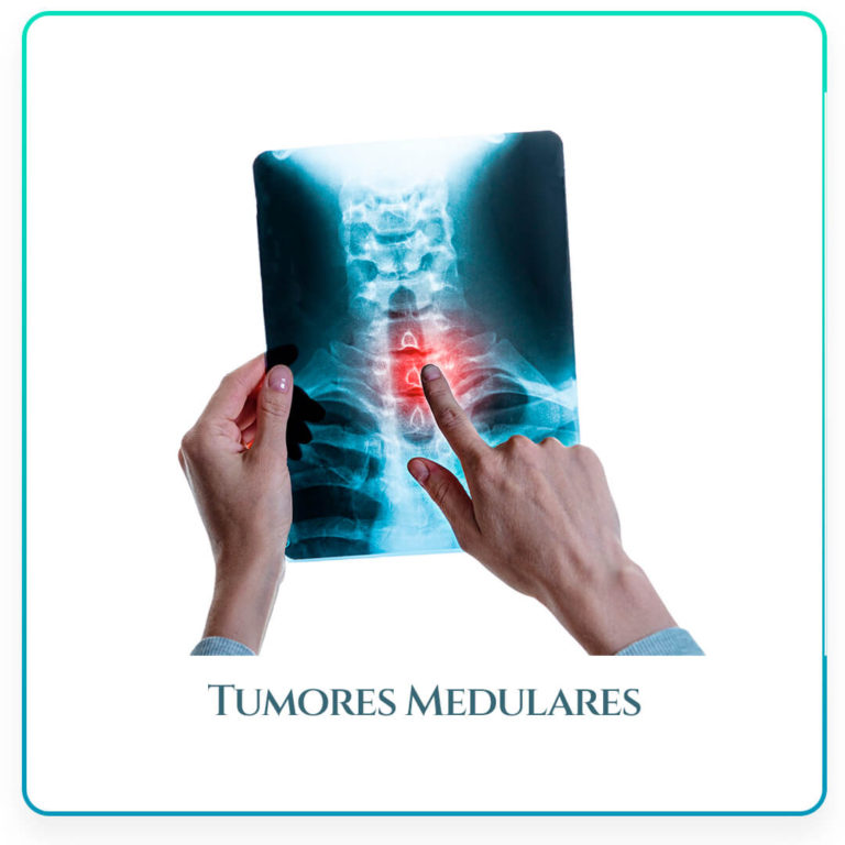 turmoes-medulares