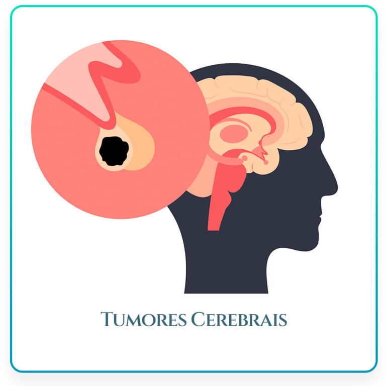 turmor-cerebral